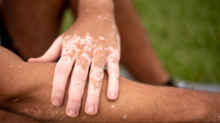 Thuốc điều trị trúng đích mở ra nhiều hy vọng cho người bị bệnh bạch biến.