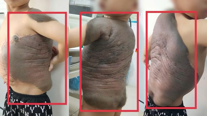 Cháu bé mang khối nơ vi hắc tố khổng lồ trên lưng suốt 7 năm.