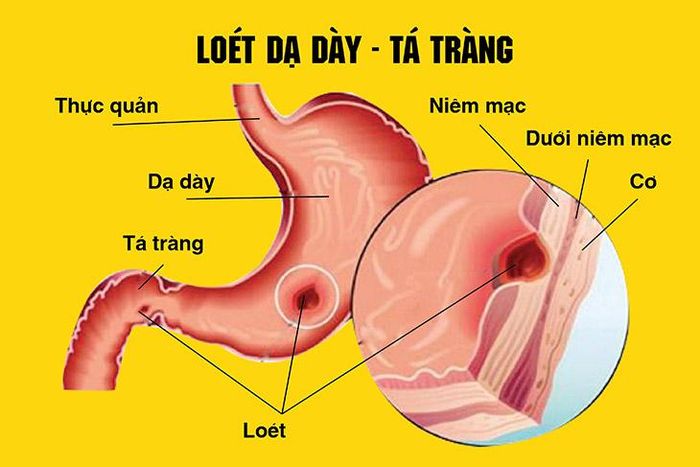 Loét dạ dày - tá tràng do tự ý dùng thuốc meloxicam.