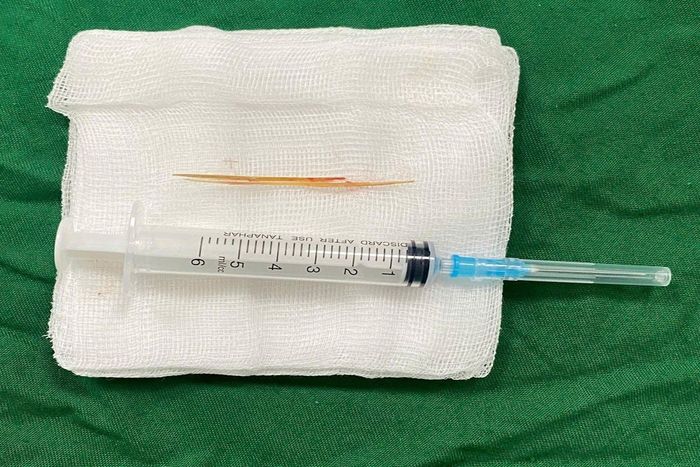 Các bác sĩ phối hợp siêu âm và nội soi để xác định vị trí dị vật, xử lý thành công ổ áp xe gan do tăm tre gây ra.