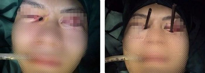 Bệnh nhân bị đũa cắm sâu vào hốc mắt (ảnh trái) và sau khi được lấy ra