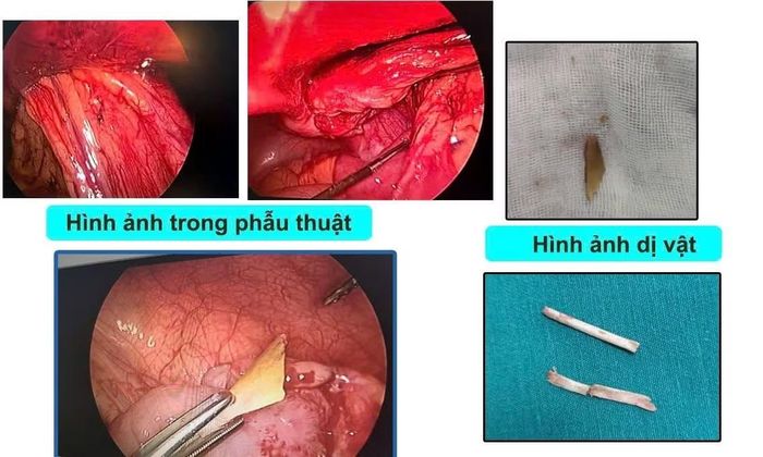 Dị vật xương lợn gây viêm phúc mạc ở bệnh nhi - Ảnh BVCC