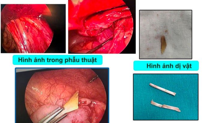 Dị vật được gắp ra.