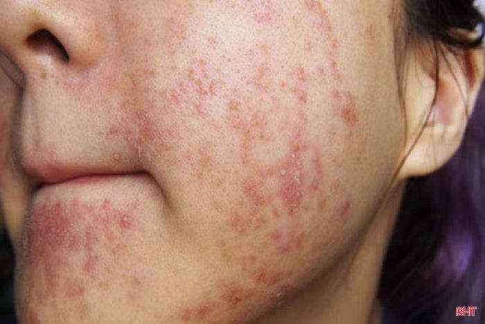Việc dùng mỹ phẩm không đảm bảo chất lượng dễ dẫn đến viêm da, dị ứng.