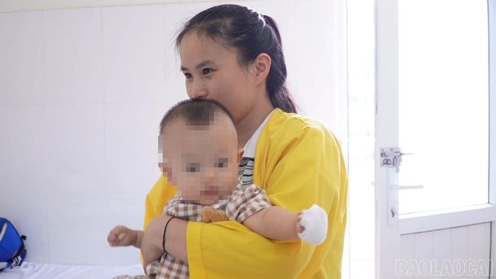 Bệnh nhi bị bỏng hơi nồi cơm.