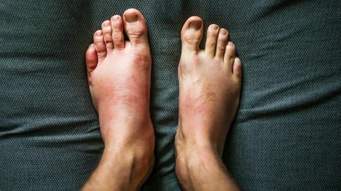 Phù nề là triệu chứng khá điển hình của bệnh thận. Ảnh: Pexels.