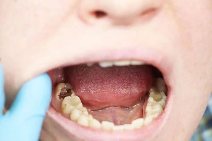 Trẻ thiếu canxi thường có nguy cơ sâu răng cao hơn, men răng yếu hoặc răng mọc chậm hơn bình thường. Ảnh: Adobe Stock. 