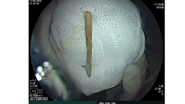  Dị vật dài 3cm được gắp ra sau phẫu thuật nội soi trực tràng 