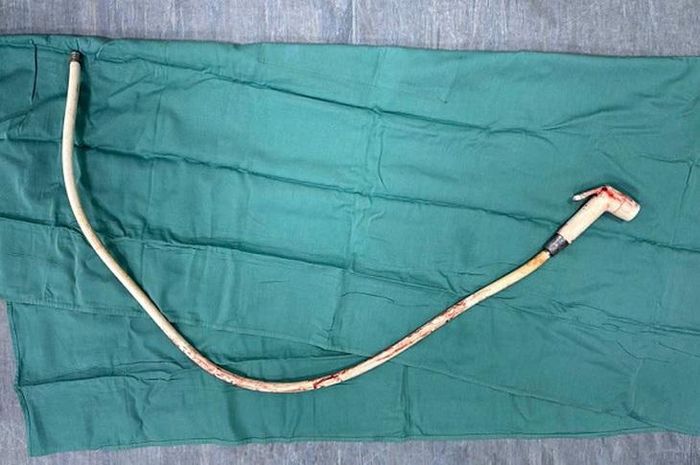Dị vật sau khi được lấy ra. Ảnh: BVCC.