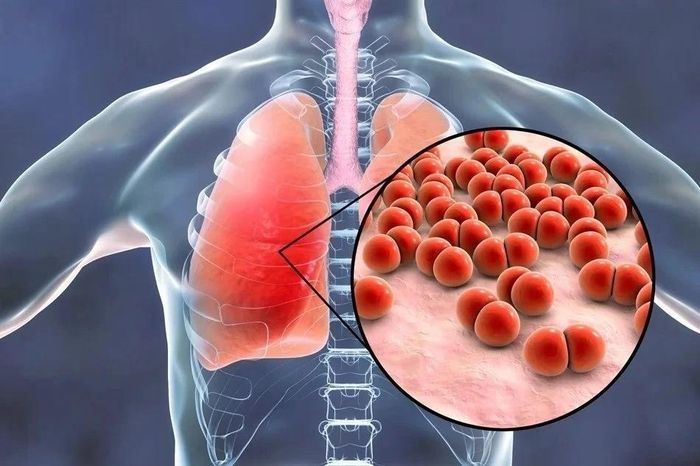  Phế cầu khuẩn có thể dẫn đến nhiễm trùng ở một số bộ phận của cơ thể. Ảnh: News-Medical. 