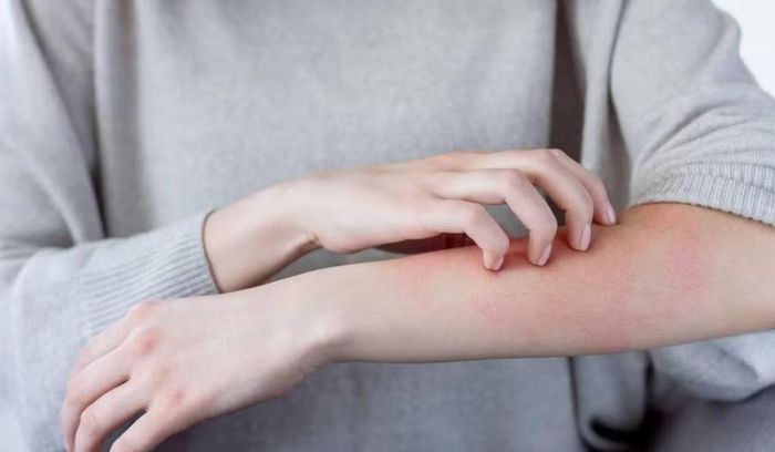 Cháy nắng không phải là chuyện nhỏ. (Ảnh: ITN).
