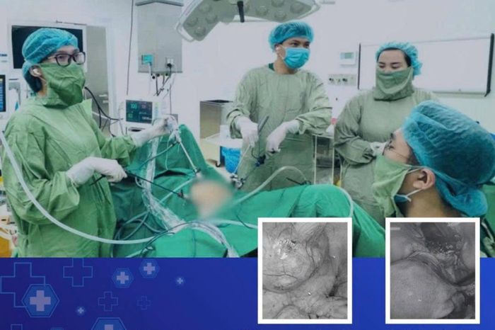 Các bác sĩ đã bóc tách khối u hoàn toàn bằng phương pháp nội soi mà không gây tổn thương đến các mô lành hoặc cơ quan nội tạng lân cận