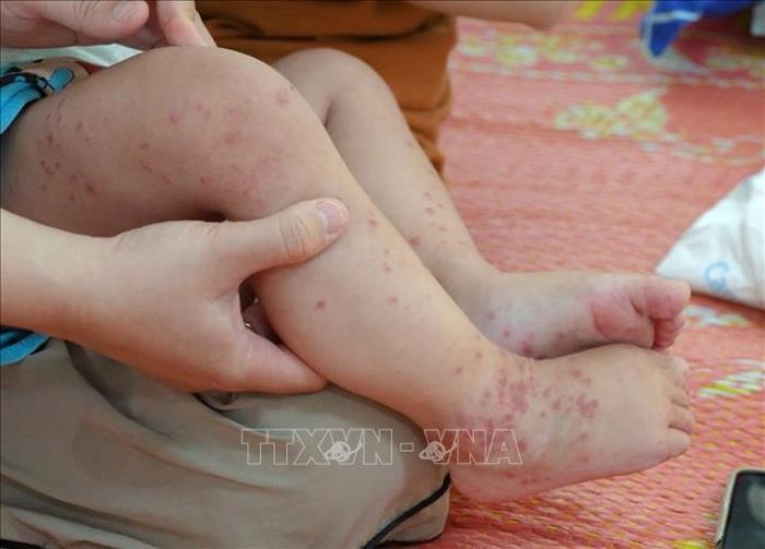Các nốt bọng trên chân trẻ mắc tay chân miệng. Ảnh tư liệu: TTXVN phát