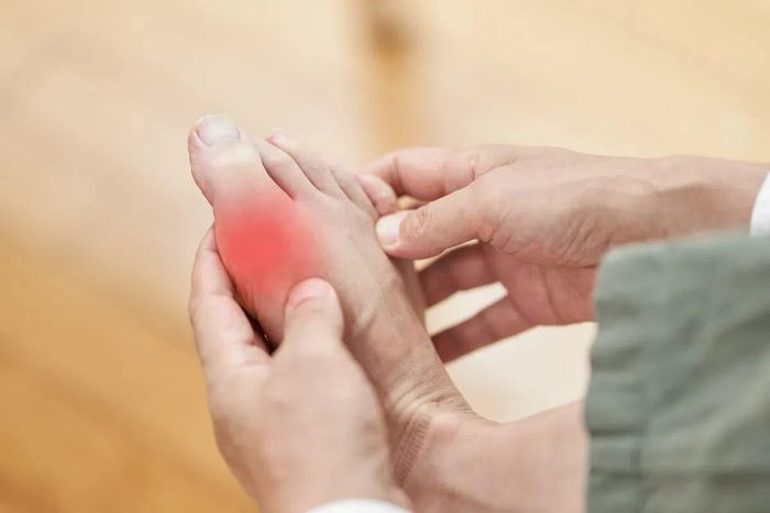 Gout xảy ra khi nồng độ axit uric trong máu tăng cao, gây lắng đọng tinh thể urat tại các khớp