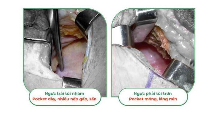 Sự khác nhau giữa túi nhám (ngực trái) và túi trơn (ngực phải)