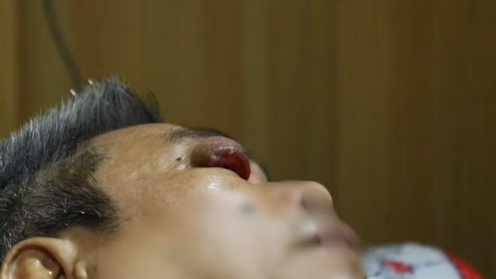 Hốc mắt bệnh nhân sưng to.