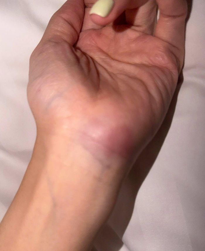 Diễn viên Thanh Hương đăng ảnh tay chân bị thương, mẩn ngứa khi đóng phim mới, kèm trạng thái: "Không có vai nhỏ, chỉ có người diễn viên nhỏ thôi".