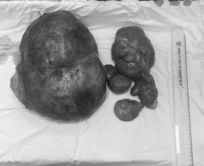 Khối u ổ bụng nặng gần 8kg được lấy trọn vẹn và an toàn khỏi cơ thể người bệnh - Ảnh BVCC