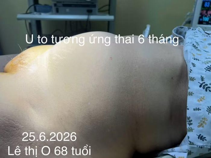 Khối u khiến bụng bệnh nhân to bất thường. Ảnh: Kiên Quyết