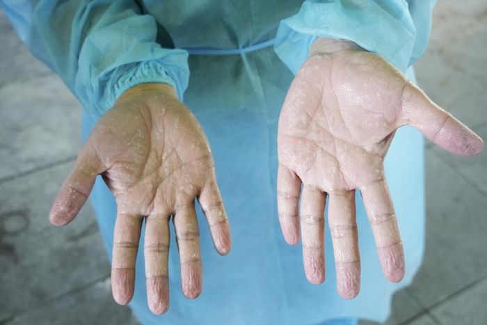  Bàn tay của kỹ thuật viên Tổ lấy mẫu sau nhiều giờ đeo găng tay trong môi trường nhiệt độ cao. (Ảnh: T.L) 