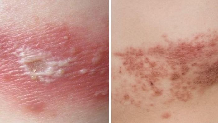 Triệu chứng tổn thương trên da do kiến ba khoang (bên trái) và zona thần kinh (bên phải)