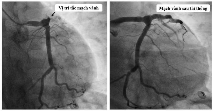 Hình ảnh mạch bị tắc và sau khi đã được xử lý