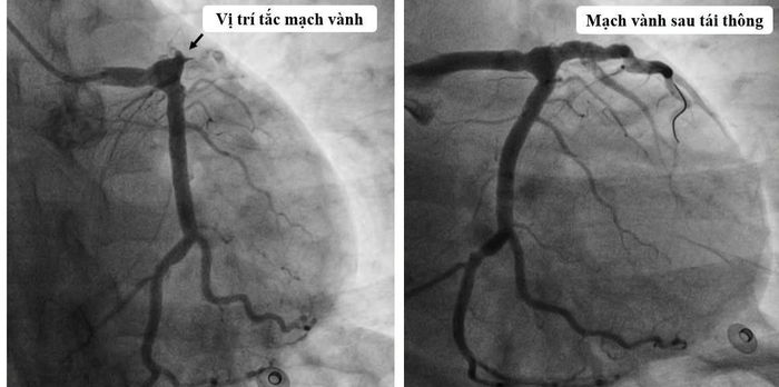  Bác sĩ bất ngờ vì tổn thương động mạch vành rất nặng, hiếm gặp ở người trẻ. 