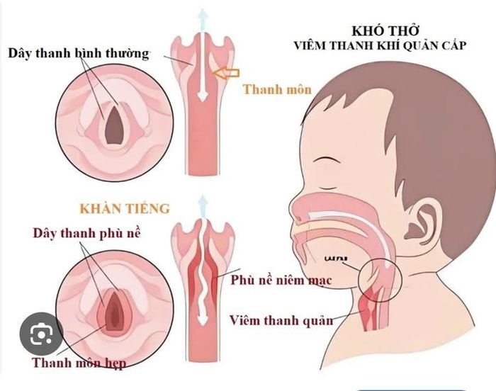 Sai lầm nguy hiểm nhất mà nhiều gia đình đang mắc phải là tự ý dùng kháng sinh và corticoid cho trẻ tại nhà mà không có chỉ định của bác sĩ