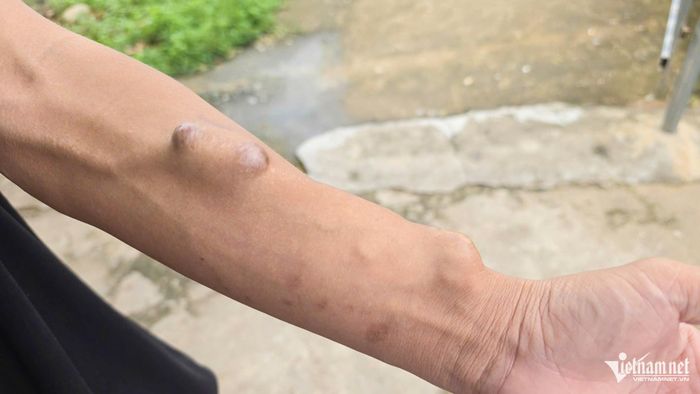 Cánh tay sưng phồng với những mạch máu nổi rõ là dấu vết của những lần chạy thận nhân tạo để duy trì sự sống của anh Chức