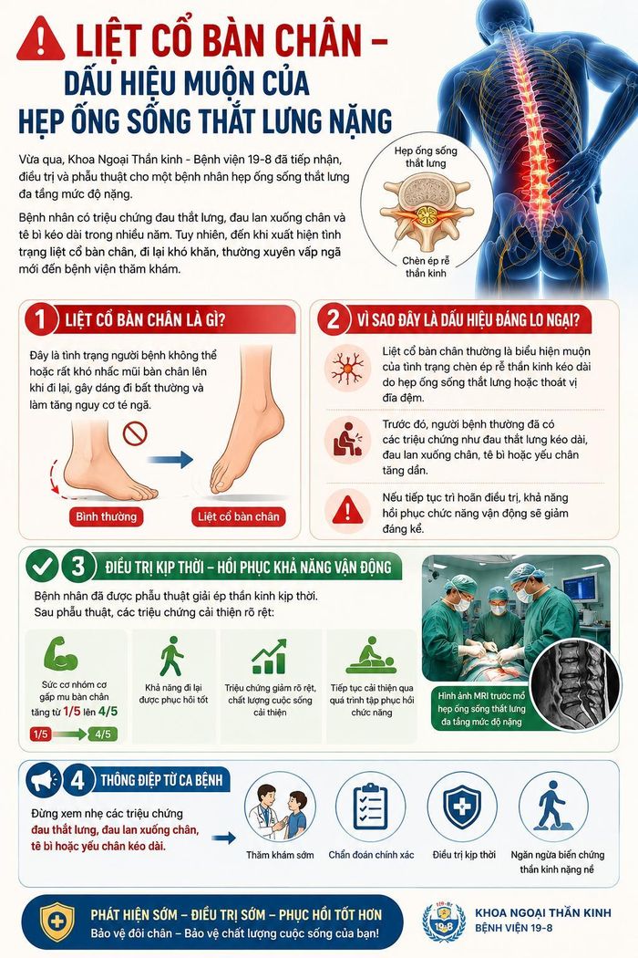 Liệt cổ bàn chân có thể là dấu hiệu muộn của hẹp ống sống thắt lưng do chèn ép rễ thần kinh kéo dài. Phát hiện và điều trị sớm giúp tăng khả năng phục hồi chức năng vận động, hạn chế biến chứng.
