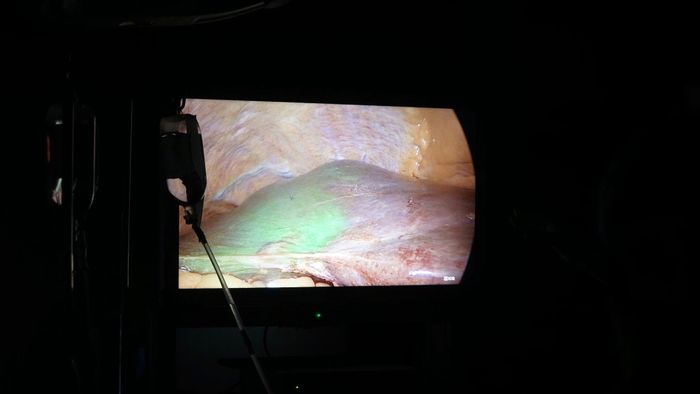 Bệnh nhân được chẩn đoán ung thư gan giai đoạn II với khối u ở gan trái kích thước khoảng 6 cm