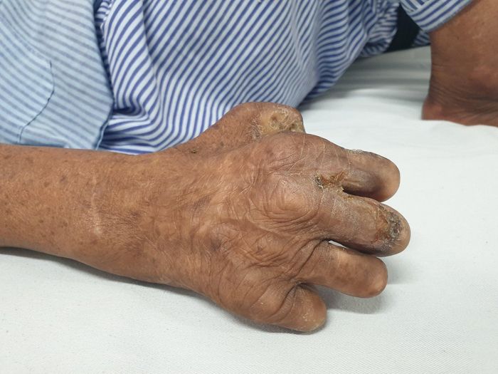 Bệnh phong với những di chứng để lại lâu dài