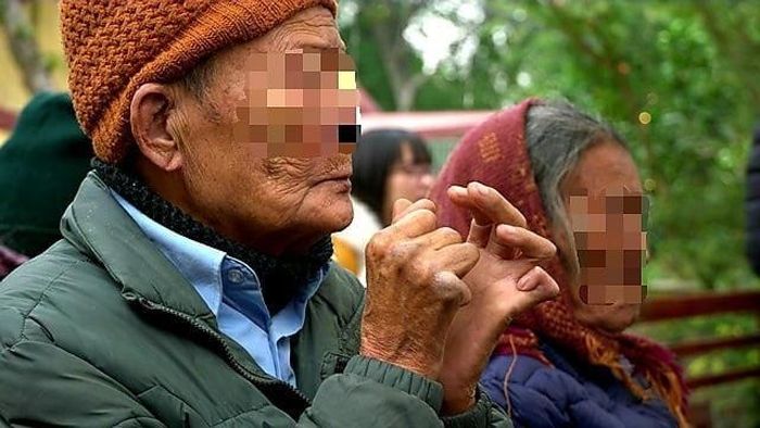 Người bệnh phong điều trị tại BV Da liễu Bắc Ninh.