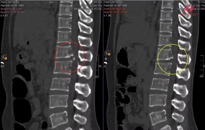 Tổn thương cột sống trên phim chụp - Ảnh BVCC