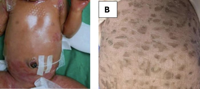 Bệnh nhi lúc 3 ngày tuổi bị đỏ da toàn thân, da căng bóng, có màng bọc; hình B cho thấy tình trạng khô da, bong vảy dày lan tỏa thân mình. Ảnh: BSCC
