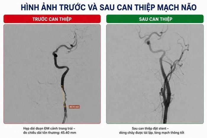 Hình ảnh trước và sau can thiệp mạch não