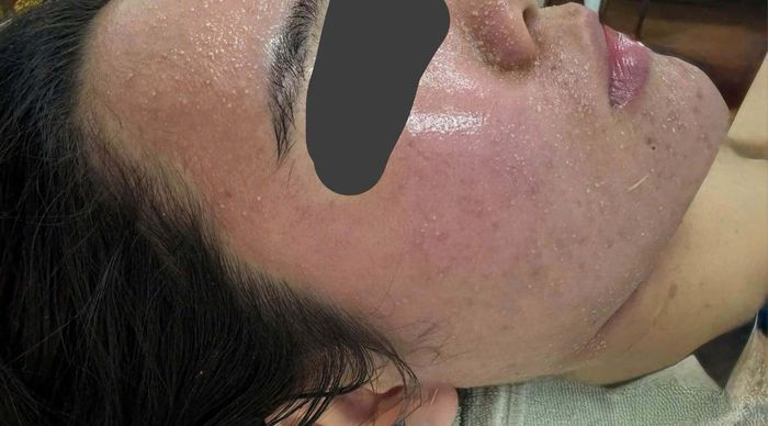 Mặt sưng phù, nổi kín mụn sau vài lần dùng mỹ phẩm dưỡng trắng mua trên mạng (Ảnh: BVCC)