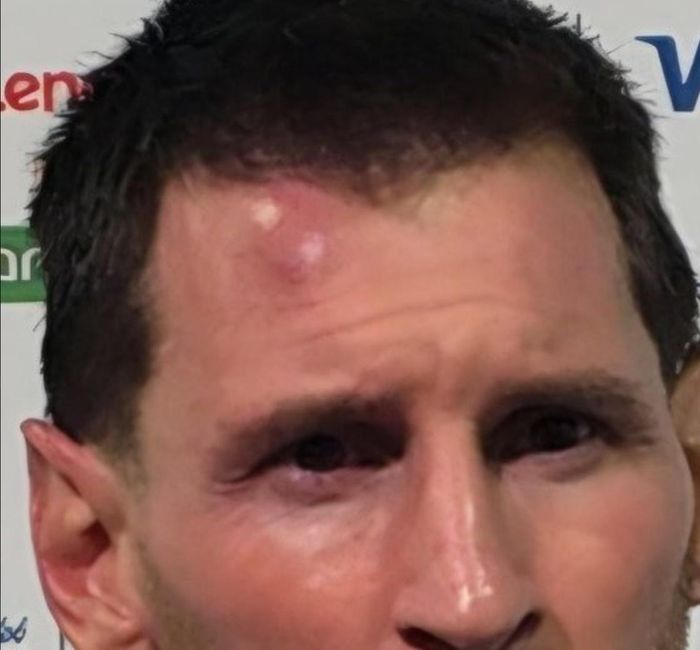 Vết sưng lộ rõ của Messi.