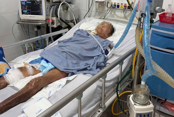  Bệnh nhân phải hồi sức tích cực suốt hơn một tháng mới giữ được tính mạng. Ảnh: BVCC. 