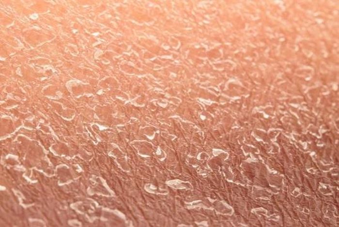 Không ít trẻ vảy cá bẩm sinh bị phát hiện muộn do gia đình nghĩ chỉ là khô da. Ảnh: BVCC.