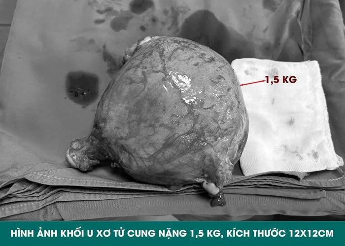 Hình ảnh khối u sau mổ. Ảnh: BVCC