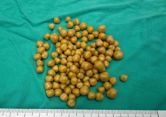 "Khối u" thực chất là túi mật chứa 130 viên sỏi. Ảnh: ETToday.