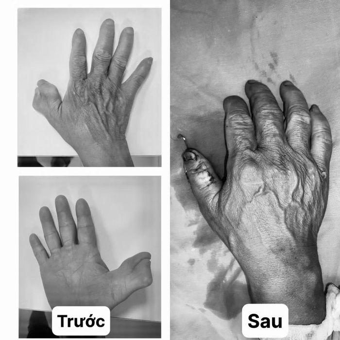 Ngón tay thừa trước và sau phẫu thuật - Ảnh BVCC