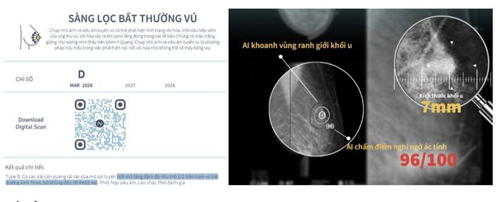 Nốt tổn thương trên ảnh chụp Mammography vú, báo cáo sức khỏe đánh giá mức D - khuyến nghị thăm khám chuyên sâu