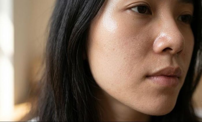 Da dầu thường đi kèm với sự bóng nhờn, lỗ chân lông to và nguy cơ nổi mụn.