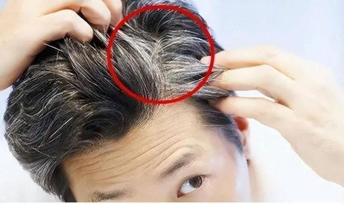 Tóc trắng mọc hai bên thái dương. Ảnh minh họa.