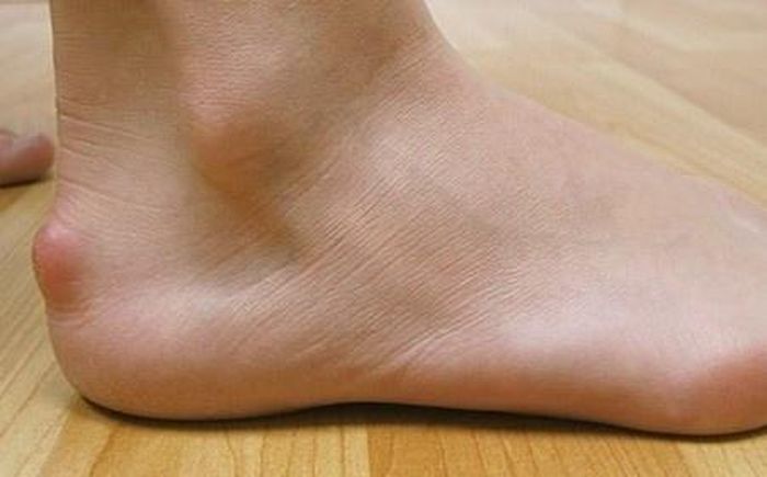  Gót chân người bệnh Haglund. Ảnh: Medical News Today. 
