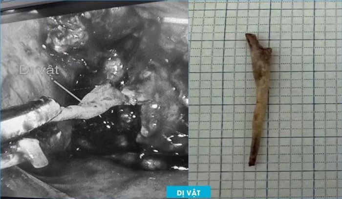 Phẫu thuật nội soi lấy xương cá cho bệnh nhân - Ảnh BVCC