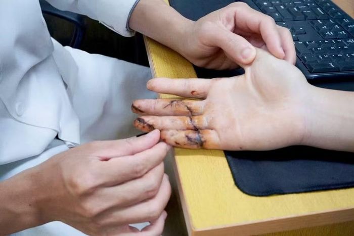Hiện, các ngón tay sống hoàn toàn và vượt qua giai đoạn nguy hiểm của phẫu thuật.