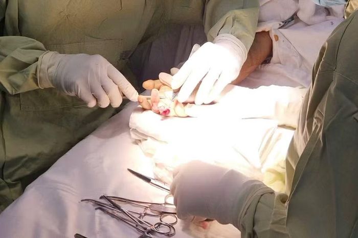 Các bác sĩ thực hiện cấp cứu vi phẫu khẩn cấp bảo tồn ngón tay cho bệnh nhân.